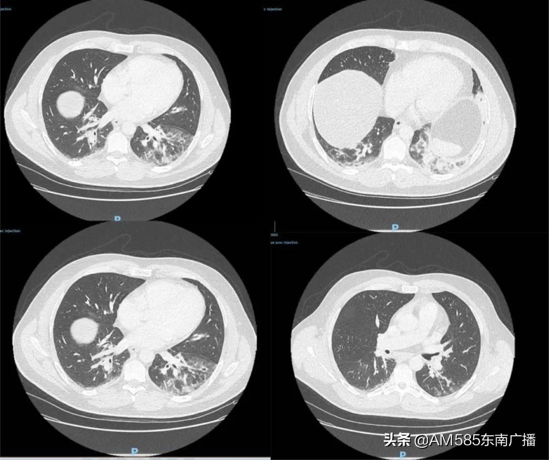 法国新冠确诊病例最新情况解析